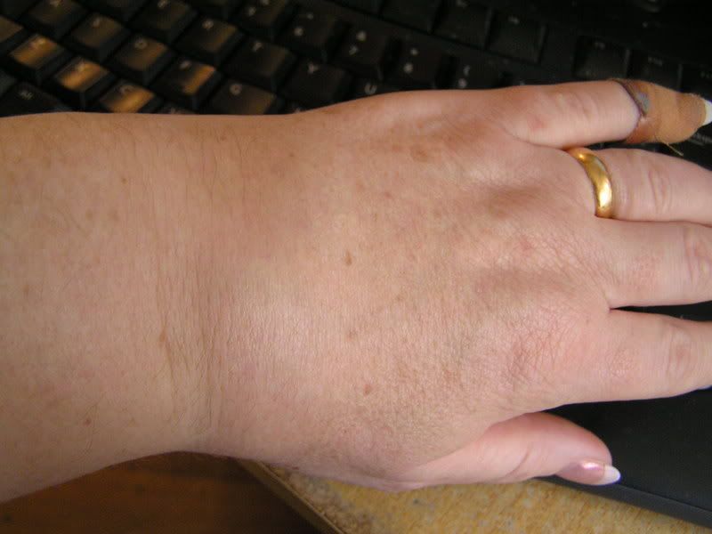 Looking for pictures of early swelling in wrists Arthritis Information
