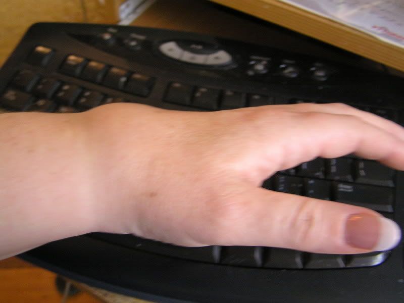 Looking for pictures of early swelling in wrists | Arthritis Information